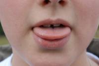 Phénotype langue en gouttière (vue 2) : un caractère  mendélien ?